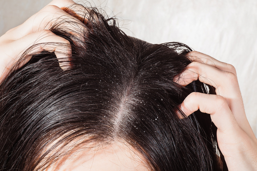 Got an Itchy Scalp? Those Flakes Might Not Be Dandruff After All